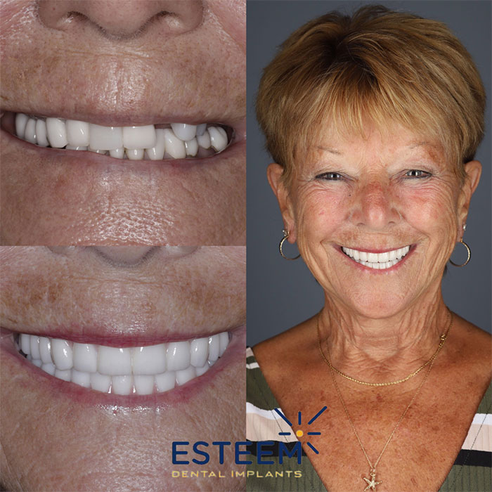 esteem before and after case