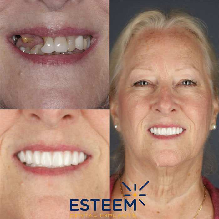 esteem before and after case